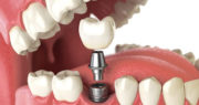 خطرات کوتاه و بلند مدت ایمپلنت‌های دندان